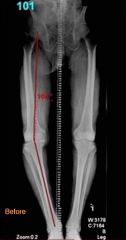 This is a before and after example demonstrating a varus (bow legged) correction possible with knee replacement surgery
