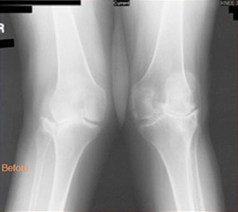 This is a before and after example demonstrating a valgus (knock-kneed) correction possible with knee replacement surgery.