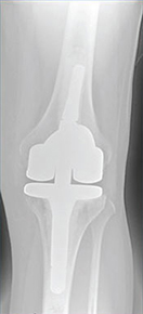 Revision Total Knee Replacement	