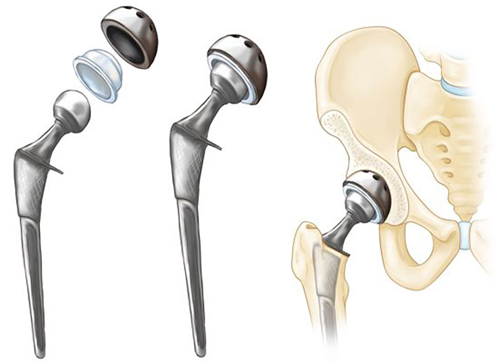 Hip and Knee Replacement Parts and Materials - Stephen J. Incavo, MD